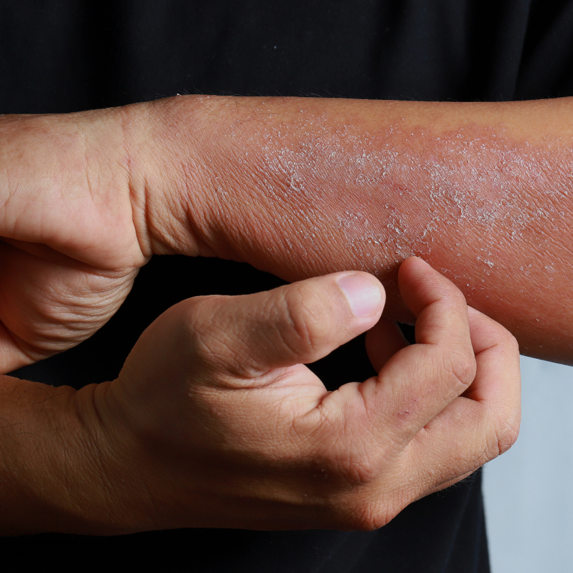 Close-up of a person's arm with a scratch and hand holding it